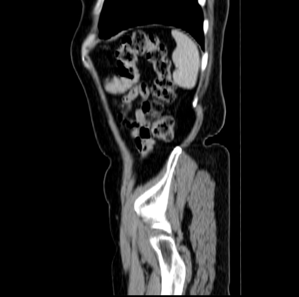 Colon carcinoma with hepatic metastases (Radiopaedia 29477-29961 C 49).jpg