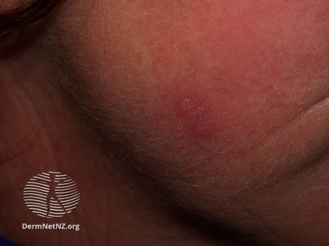 Cutaneous lupus erythematosus (DermNet NZ immune-lupus-erythematosus-2540).jpg