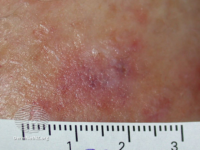 Intraepidermal carcinoma (DermNet NZ lesions-scc-in-situ-2932).jpg