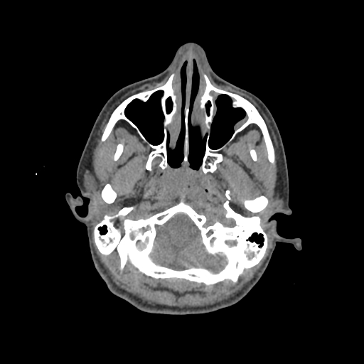 Nasal pyogenic granuloma (lobular capillary hemangioma) (Radiopaedia 85536-101244 Axial non-contrast 50).jpg