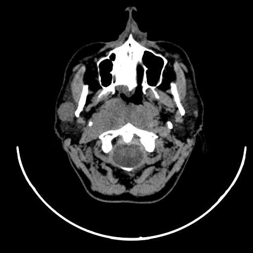 File:Nasopharyngeal carcinoma - infiltrating the clivus (Radiopaedia 62583-70875 Axial non-contrast 20).jpg