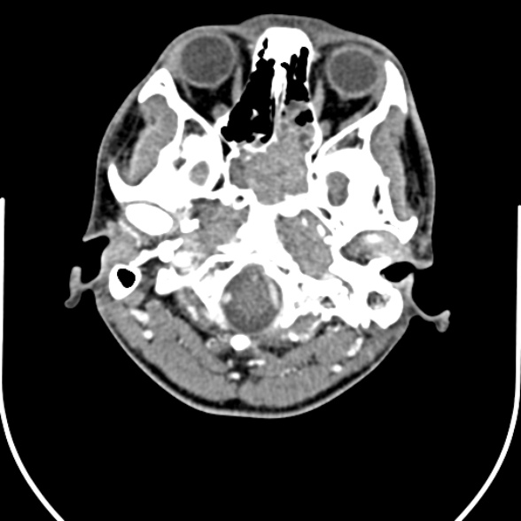 Nasopharyngeal carcinoma with skull base invasion (Radiopaedia 53415-59705 A 26).jpg