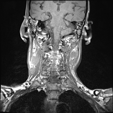 File:Nasopharyngeal carcinoma with skull base invasion (Radiopaedia 59258-66600 Coronal T1 8).jpg