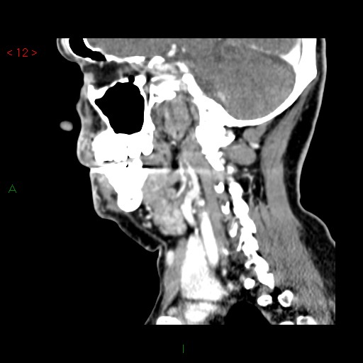 File:Nasopharyngeal lymphoma (Radiopaedia 54235-60432 B 25).jpg
