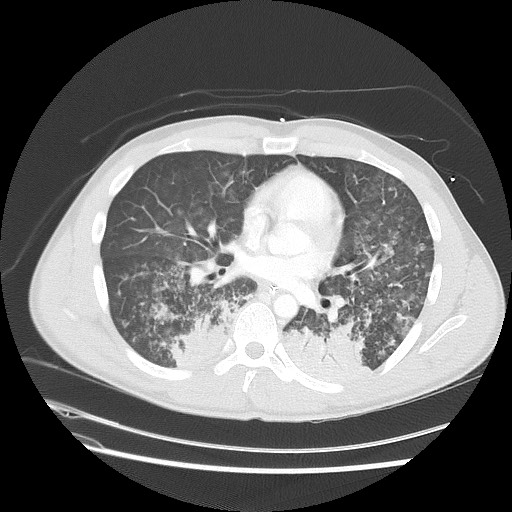 Near-drowning pulmonary edema (Radiopaedia 59457-66814 Axial lung window 32).jpg