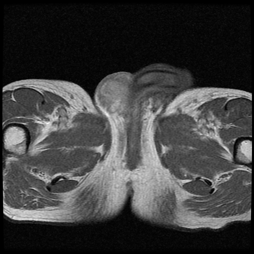 File:Necrotizing epididymo-orchitis with intra-testicular abscess (Radiopaedia 29397-29860 Axial T1 C+ 11).jpg