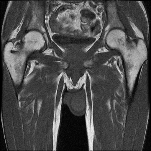 File:Necrotizing epididymo-orchitis with intra-testicular abscess (Radiopaedia 29397-29860 Coronal T1 15).jpg