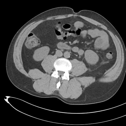File:Necrotizing pancreatitis with acute necrotic collections (Radiopaedia 38829-41012 Axial non-contrast 46).png