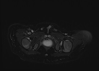 Neonatal prostatic utricle abscess - cyst (Radiopaedia 69511-79394 Axial T2 fat sat 9).jpg