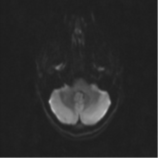 Neurenteric cyst (Radiopaedia 58641-65837 Axial DWI 43).png