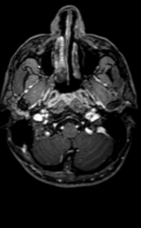 Neuro-Behçet disease (Radiopaedia 90112-107294 Axial T1 C+ 189).jpg
