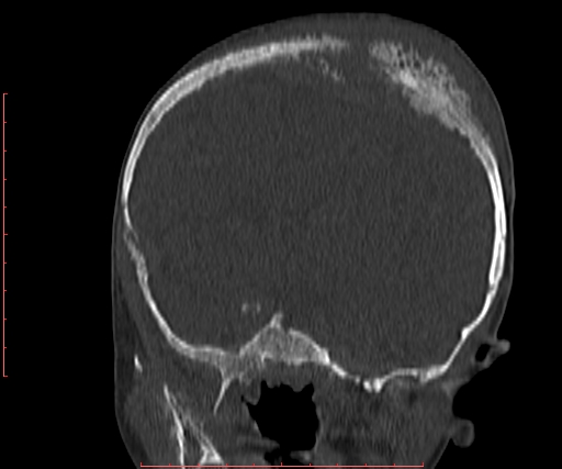 File:Neuroblastoma skull metastasis (Radiopaedia 56053-62683 Coronal bone window 17).jpg