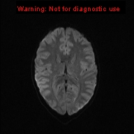 File:Neurofibromatosis type 1 with optic nerve glioma (Radiopaedia 16288-15965 Axial DWI 34).jpg