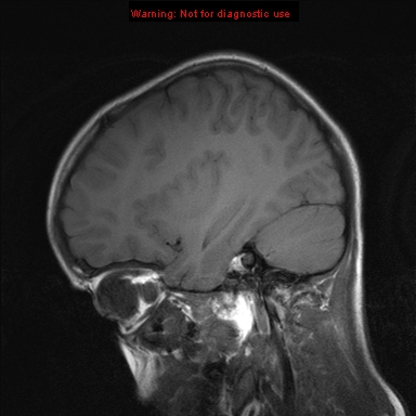 File:Neurofibromatosis type 1 with optic nerve glioma (Radiopaedia 16288-15965 Sagittal T1 7).jpg