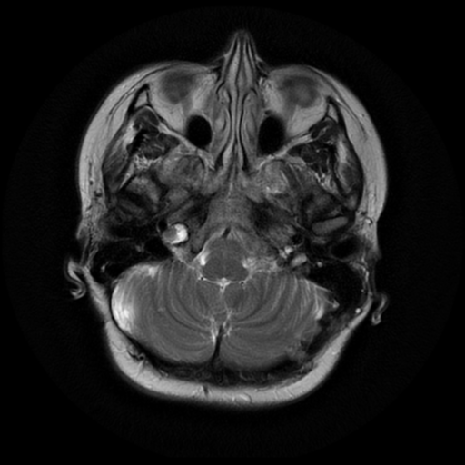 File:Neurofibromatosis type 2 (Radiopaedia 45229-49247 Axial T2 5).png