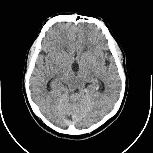 Neurofibromatosis type 2 (Radiopaedia 79097-92047 Axial non-contrast 25).jpg