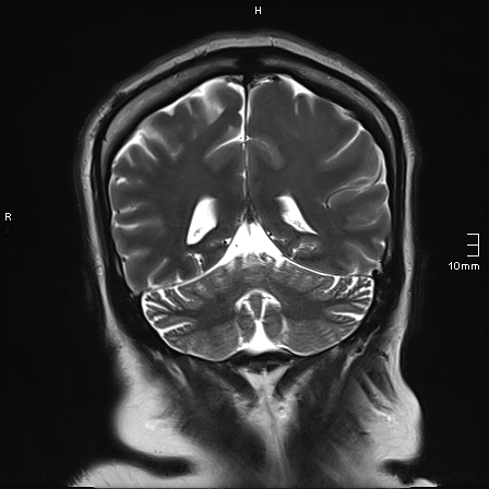 File:Neurotoxoplasmosis - concentric target sign (Radiopaedia 70644-80784 Coronal T2 16).jpg
