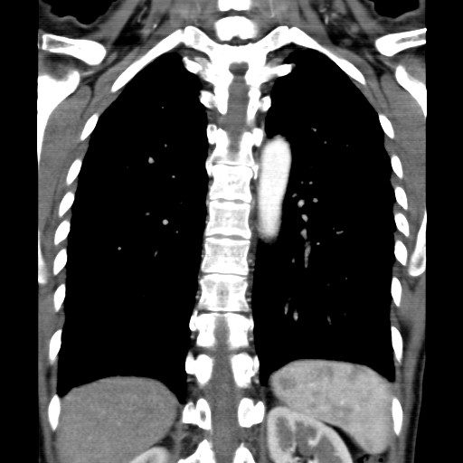 File:Non-small cell lung cancer with miliary metastases (Radiopaedia 23995-24193 B 16).jpg