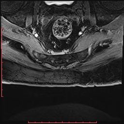 Non Hodgkin's lymphoma with metastasis to spine (Radiopaedia 54844-61103 Axial T1 C+ fat sat 49).jpg