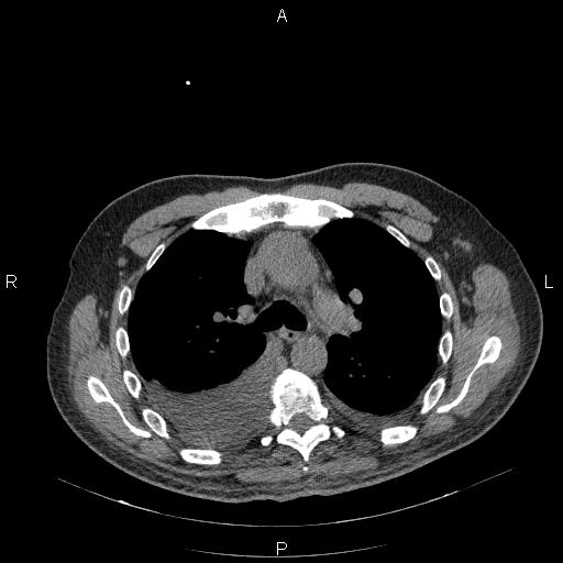 File:Non Hodgkin lymphoma in a patient with ankylosing spondylitis (Radiopaedia 84323-99624 Axial non-contrast 14).jpg
