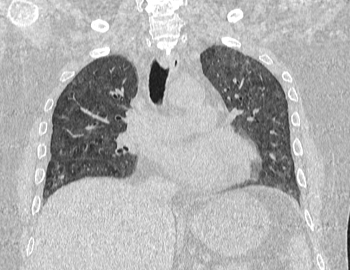 Non specific interstitial pneumonia (NSIP) (Radiopaedia 89725-106798 Coronal lung window 39).jpg
