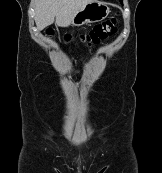 Normal CT intravenous urogram (Radiopaedia 39444-41759 A 185).jpg