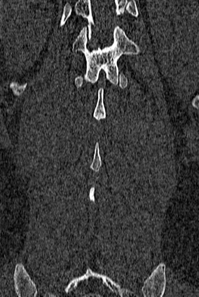 Normal CT lumbar spine (Radiopaedia 53981-60118 Coronal bone window 61).jpg