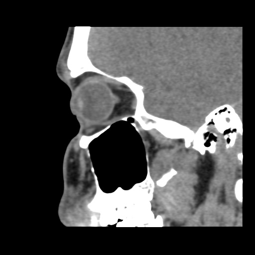 Normal CT paranasal sinuses (Radiopaedia 42286-45390 F 105).jpg