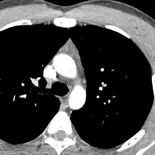 File:Normal CT pulmonary veins (pre RF ablation) (Radiopaedia 41748-44702 A 21).png