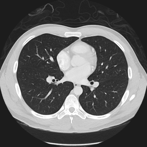 Normal CT pulmonary veins (pre RF ablation) (Radiopaedia 41748-44702 Axial lung window 27).png