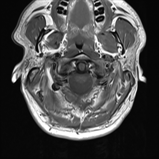 File:Normal MRI cervical spine (infection protocol) (Radiopaedia 53916-60039 Axial 9).png