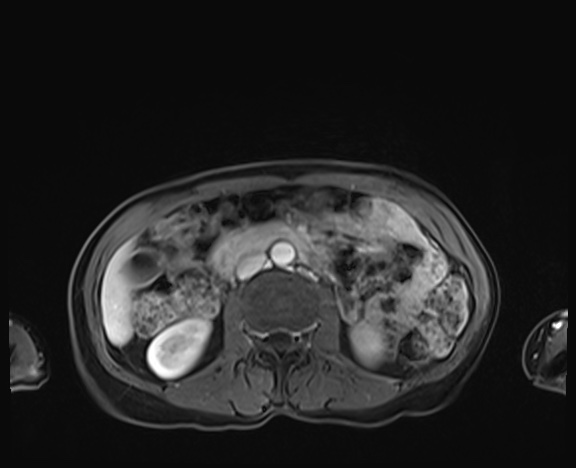 Normal adrenal glands MRI (Radiopaedia 82017-96004 K 48).jpg