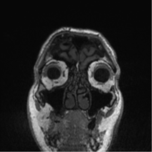 Normal brain MRI (non-focal epilepsy protocol) (Radiopaedia 53917-60040 Coronal T1 59).png