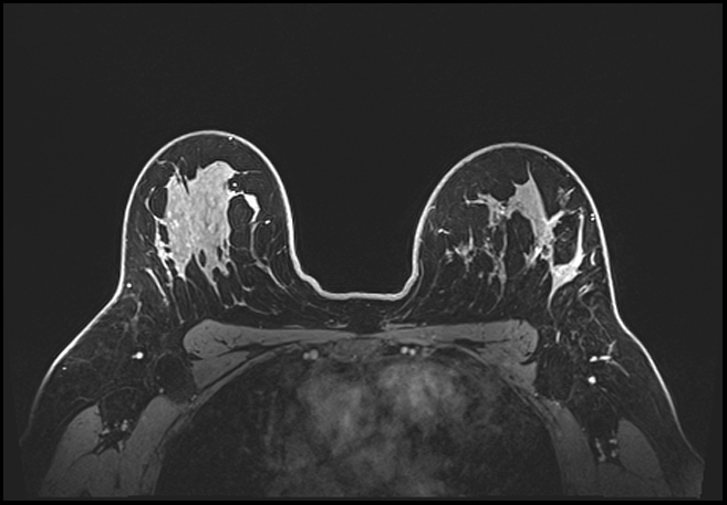 Normal breast MRI - dense breasts (Radiopaedia 80454-93850 C 150).jpg