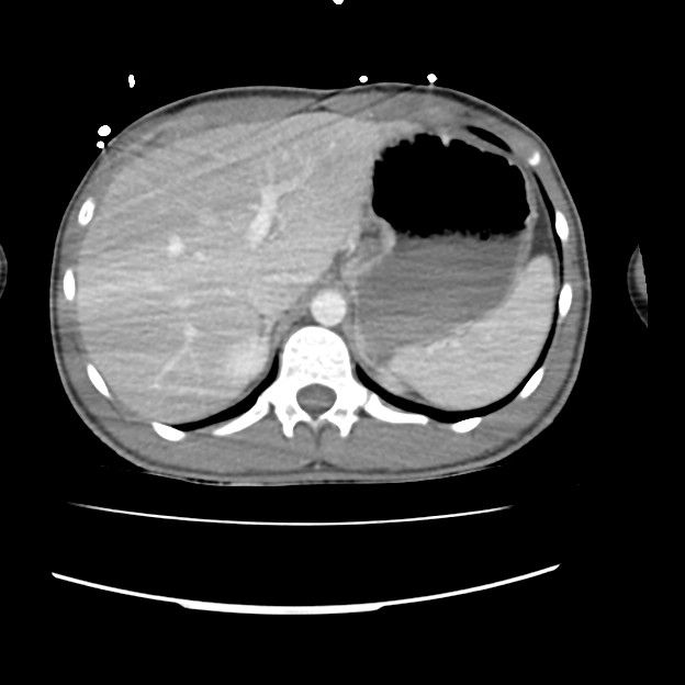 File:Normal dual-phase trauma CT chest,abdomen and pelvis (Radiopaedia ...