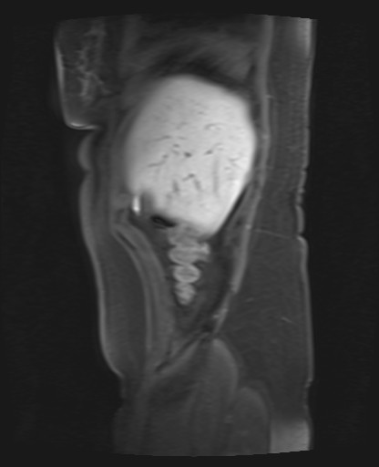 File:Normal hepatobiliary phase liver MRI (Radiopaedia 58968-66230 C 10).jpg