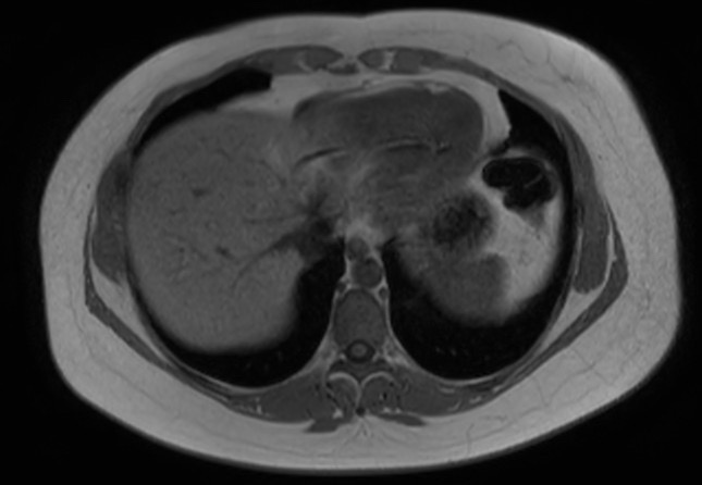 File:Normal liver MRI with Gadolinium (Radiopaedia 58913-66163 Axial T1 in-phase 28).jpg