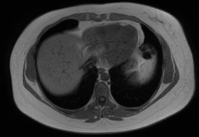 File:Normal liver MRI with Gadolinium (Radiopaedia 58913-66163 Axial T1 in-phase 29).jpg