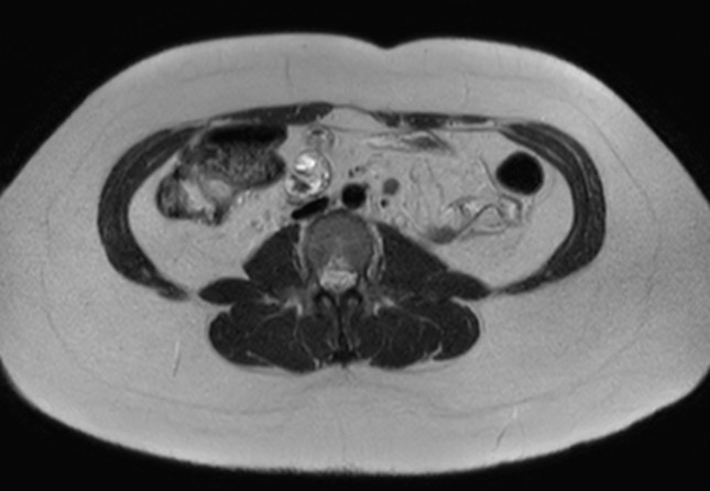 File:Normal liver MRI with Gadolinium (Radiopaedia 58913-66163 Axial T2 2).jpg