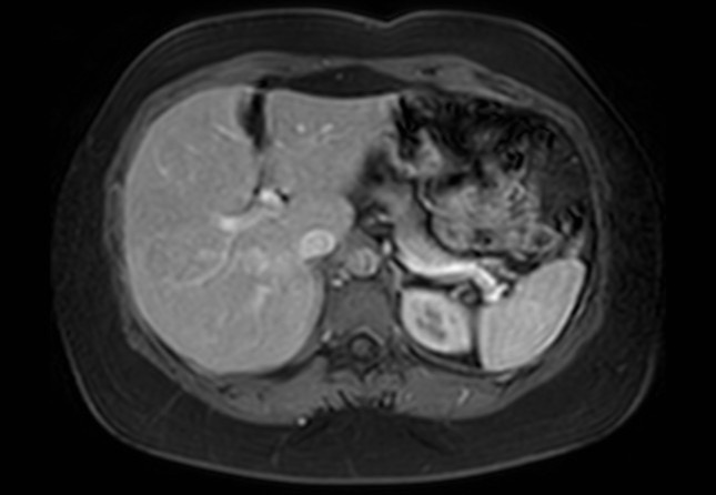 Normal liver MRI with Gadolinium (Radiopaedia 58913-66163 J 48).jpg