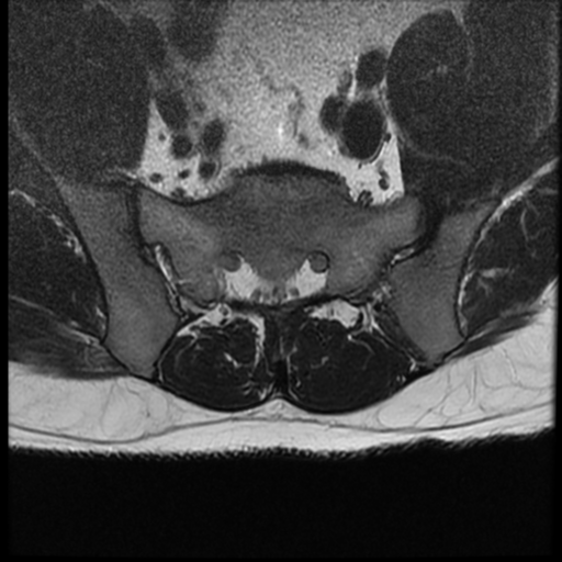 File:Normal lumbar spine MRI (Radiopaedia 35543-37039 Axial T2 3).png