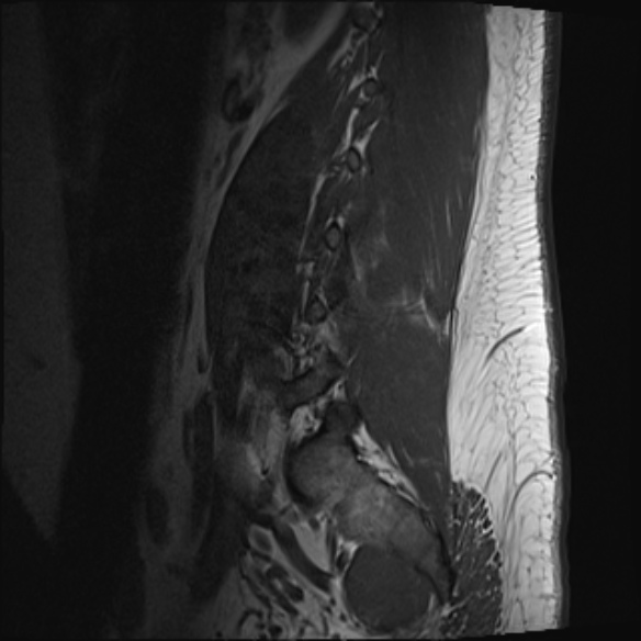 File:Normal lumbar spine MRI (Radiopaedia 47857-52609 Sagittal T1 18).jpg