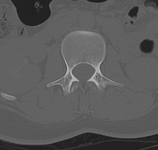 File:Normal lumbosacral CT (Radiopaedia 37923-39867 Axial bone window 41).png