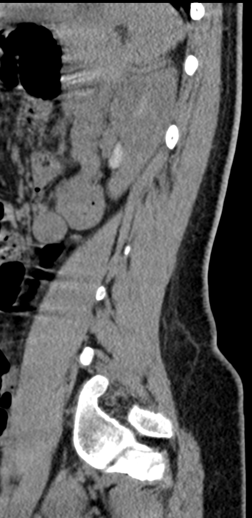 Normal lumbosacral CT (Radiopaedia 37923-39867 E 28).png