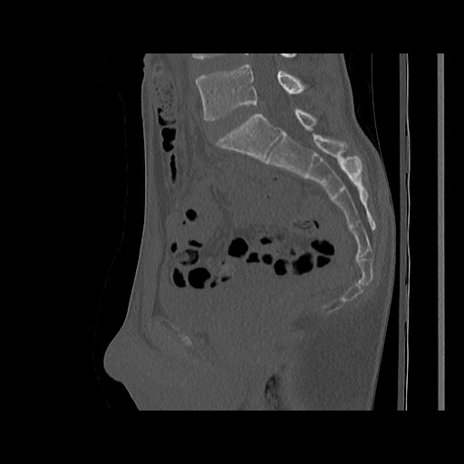 Normal pelvis (Radiopaedia 51473-57238 Sagittal bone window 75).jpg