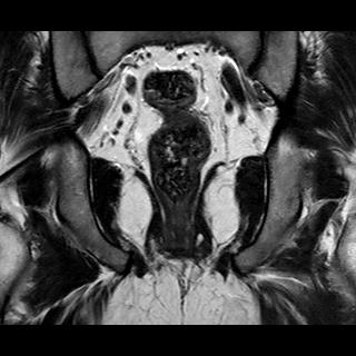 File:Normal prostate (MRI) (Radiopaedia 29986-30535 Coronal T2 17).jpg