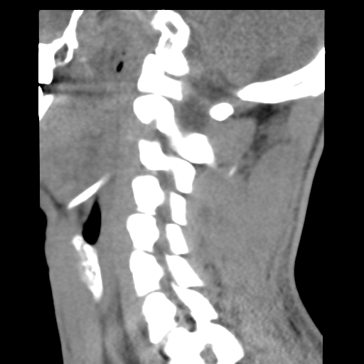 File:Normal trauma cervical spine (Radiopaedia 41017-43760 B 19).png
