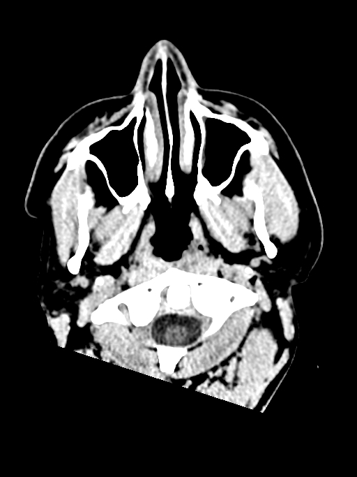Normal trauma protocol brain and C-spine CT (Radiopaedia 83302-97709 Axial non-contrast 72).jpg