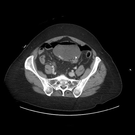 Obstructive distal colonic adenocarcinoma causing cecal perforation (Radiopaedia 86830-102989 A 147).jpg