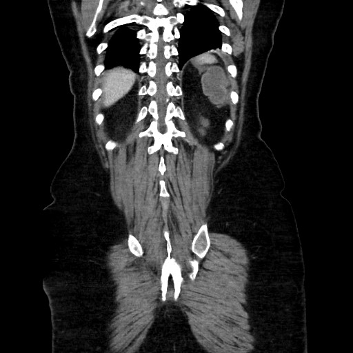 Obstructive distal colonic adenocarcinoma causing cecal perforation (Radiopaedia 86830-102989 C 143).jpg